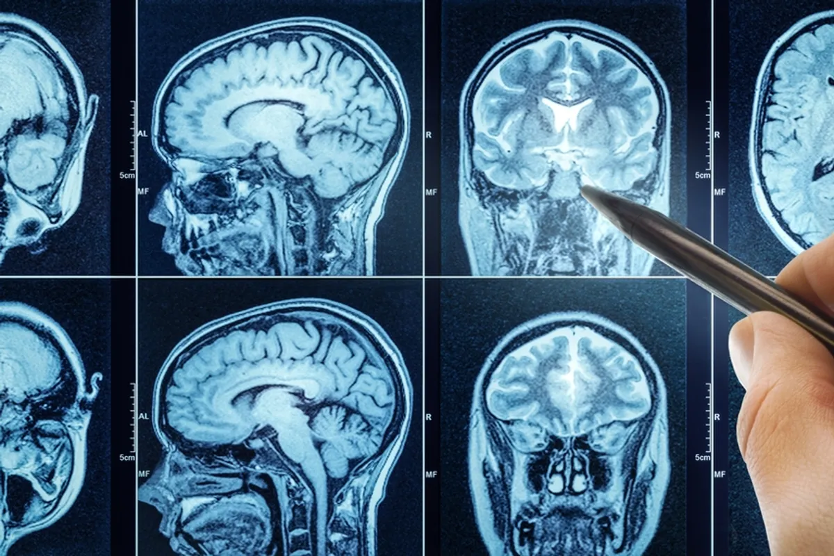 Lasers Treating Brain Cancer - Start Medical Product Development