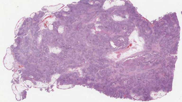 AI ovarian cancer tech - Start Medical Product Development